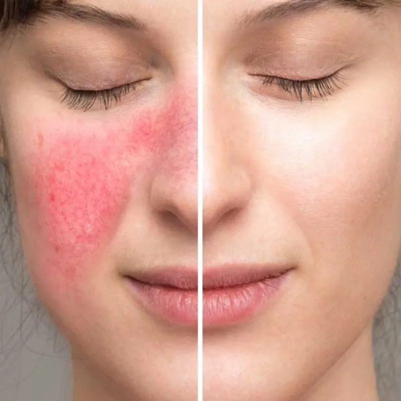 Laser co2 fractional hỗ trợ làm đều màu da