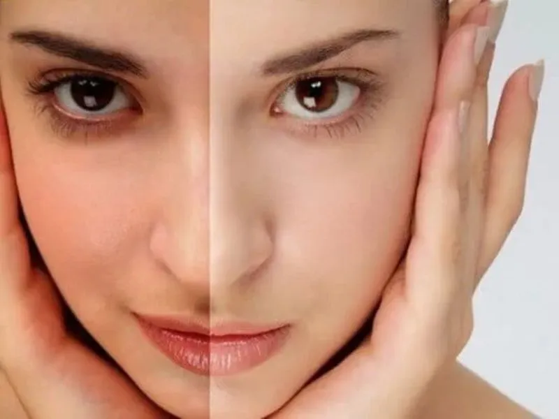 Máy hỗ trợ làm đều màu da và cải thiện tông da sáng hơn