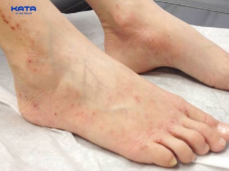 Không ngâm chân khi bàn chân đang có vết thương hở