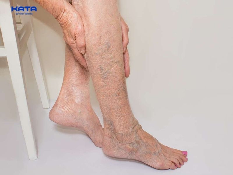Người bị suy giãn tĩnh mạch nặng không nên ngâm chân