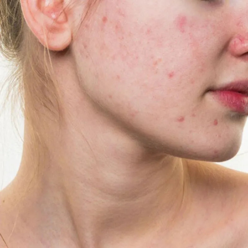 Peptide hỗ trợ giúp cải thiện mẩn đỏ, viêm da