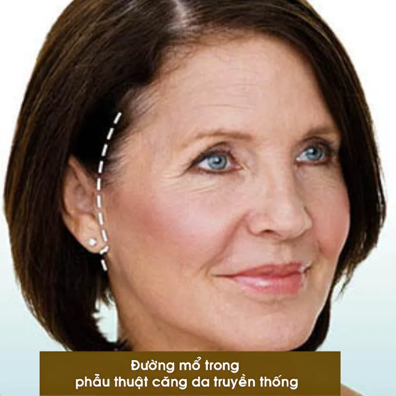Phẫu Thuật Căng Da Mặt Truyền Thống
