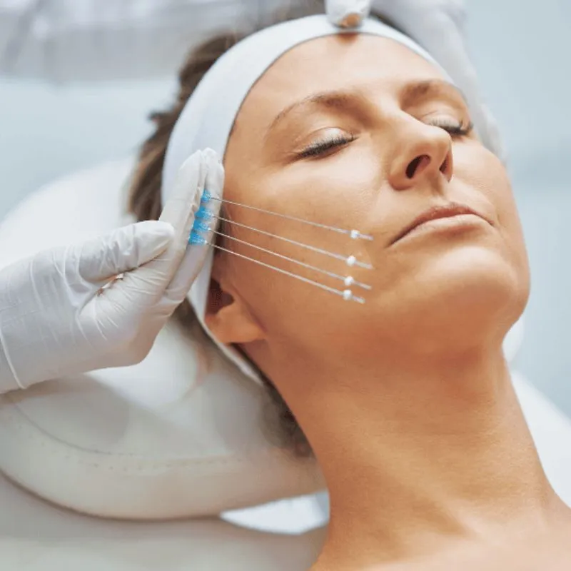 Phương pháp cấy chỉ collagen