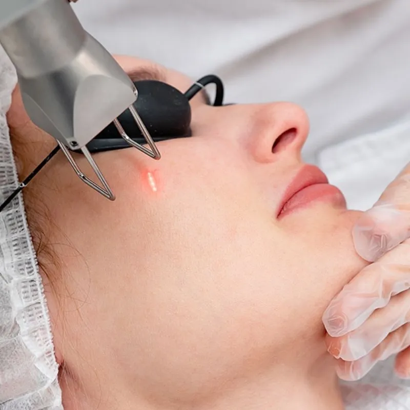 Phương pháp lăn kim trị sẹo lõm