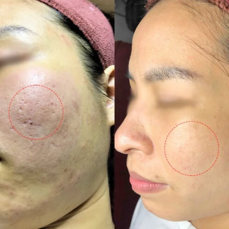 Lăn kim giúp trị sẹo lỗ hiệu quả 