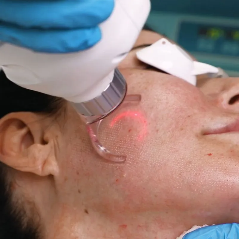 Laser CO2 có tác dụng mạnh mẽ 