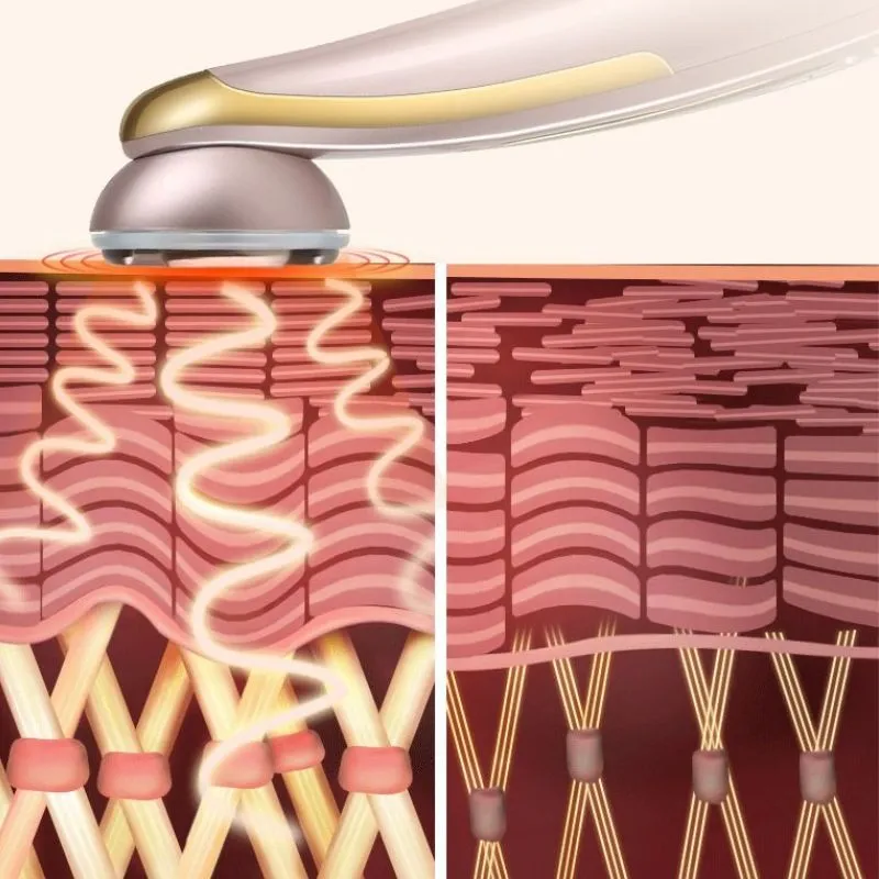 EMS gián tiếp hỗ trợ quá trình kích thích collagen