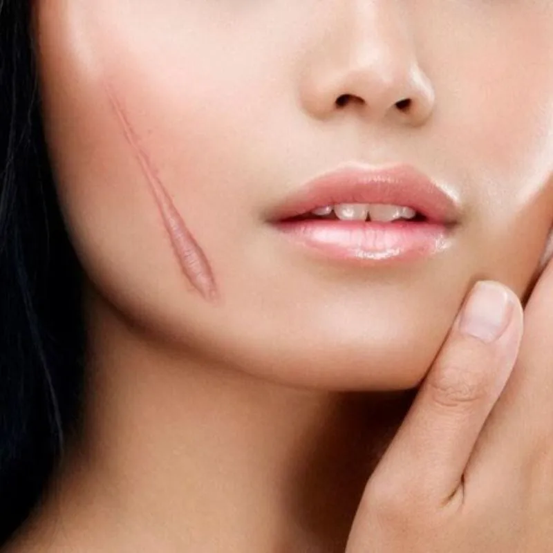 Collagen hỗ trợ điều trị sẹo và vết thương