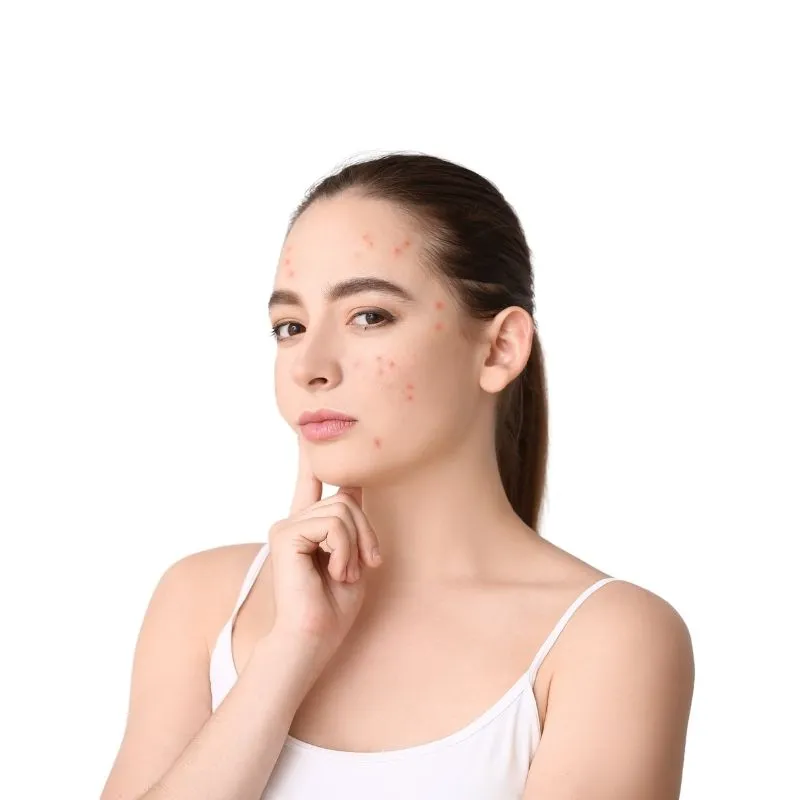 Hỗ trợ trị mụn và kiểm soát dầu 