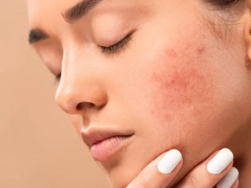Điện di lạnh làm dịu da và giảm viêm tức thì