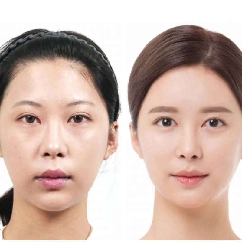 Tùy vào cơ địa mỗi người rãnh cười sẽ ổn định