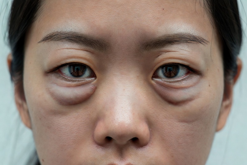 bọng mắt khiến gương mặt bạn già đi 5 tuổi