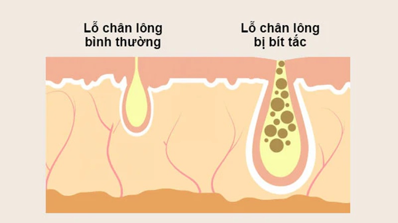 Lỗ chân lông bị bít tắc bởi mỹ phẩm, dầu thừa và bụi bẩn tích tụ lâu ngày 