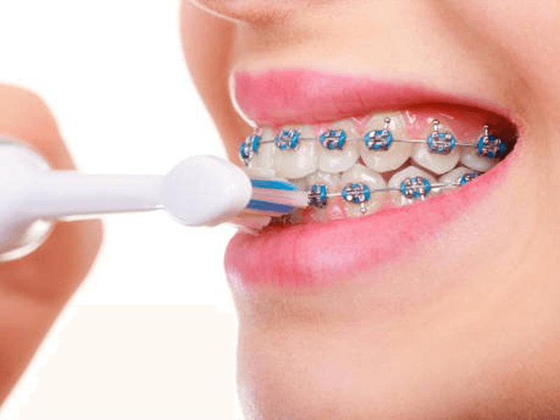 Bàn chải điện hỗ trợ người niềng răng