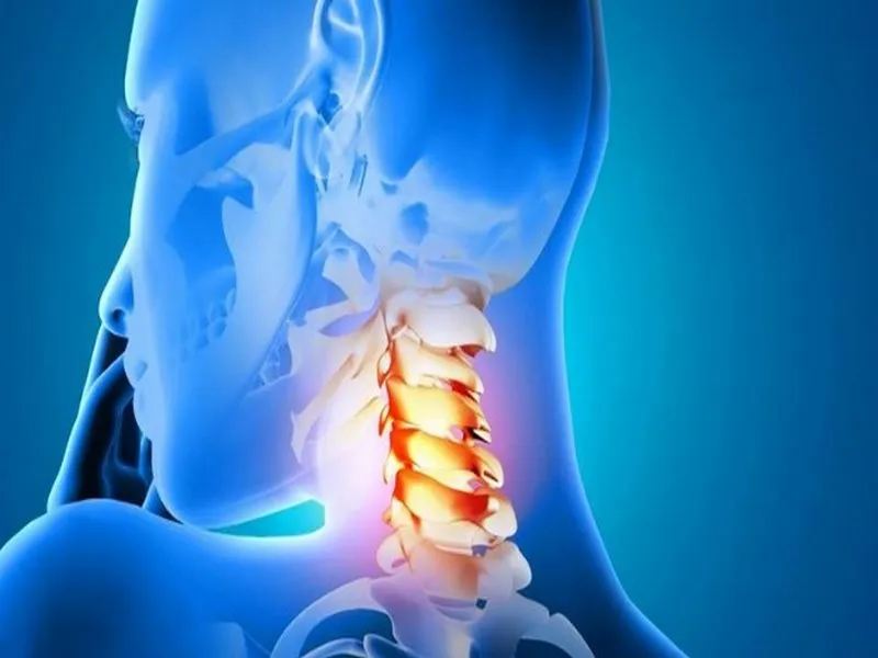 Nguyên nhân dẫn đến bị đau dây thần kinh cổ là gì?