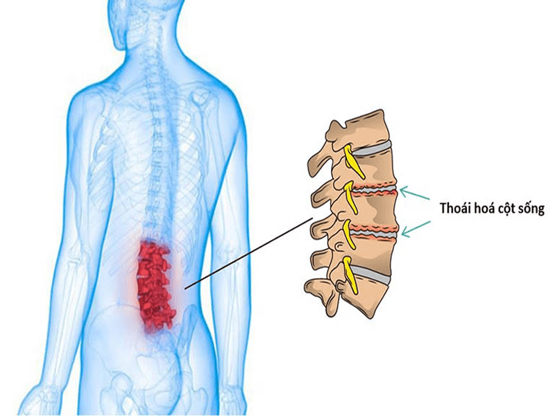 Cột sống lưng bị thoái hóa dẫn đến đau lưng dưới