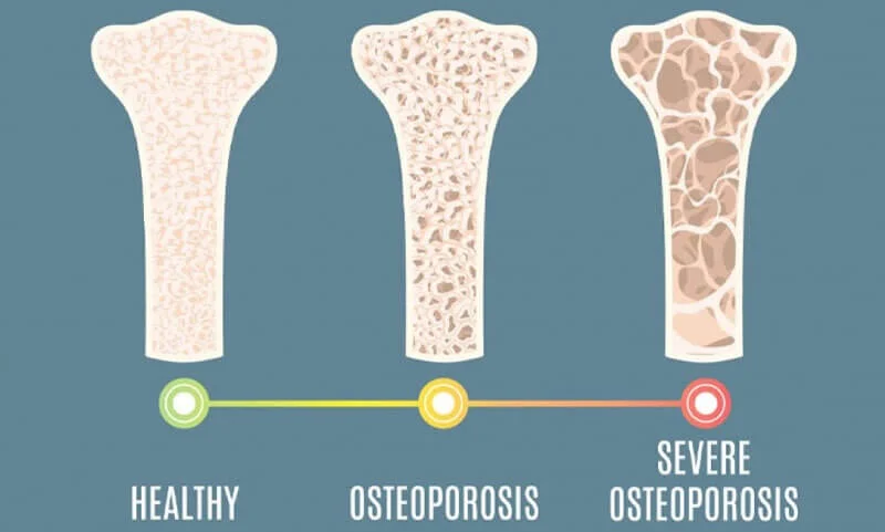 Bone Mass là chỉ số khối lượng xương có trong cơ thể