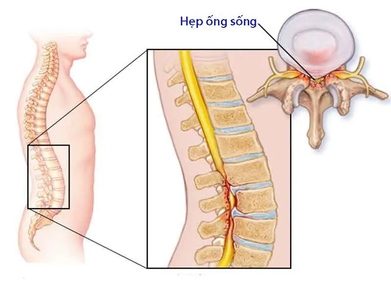 Hẹp ống sống là một trong các bệnh liên quan đến đau lưng bạn cần đề phòng. 