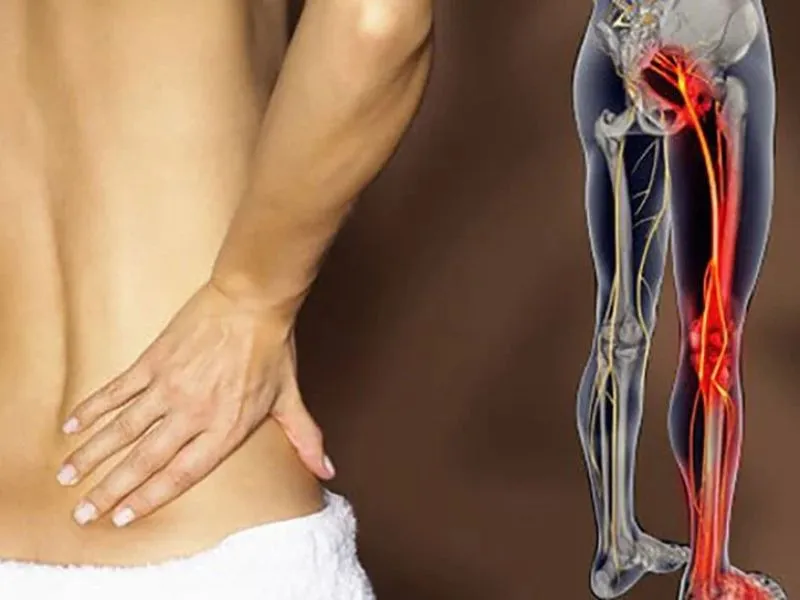 Thoát vị đĩa đệm là một trong các bệnh đau lưng phổ biến thường thấy