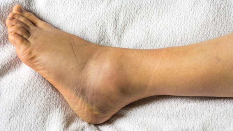 Để giảm tình trạng phù nề chân, người bệnh nên thường xuyên tập thể dục, chú trọng vào đôi chân