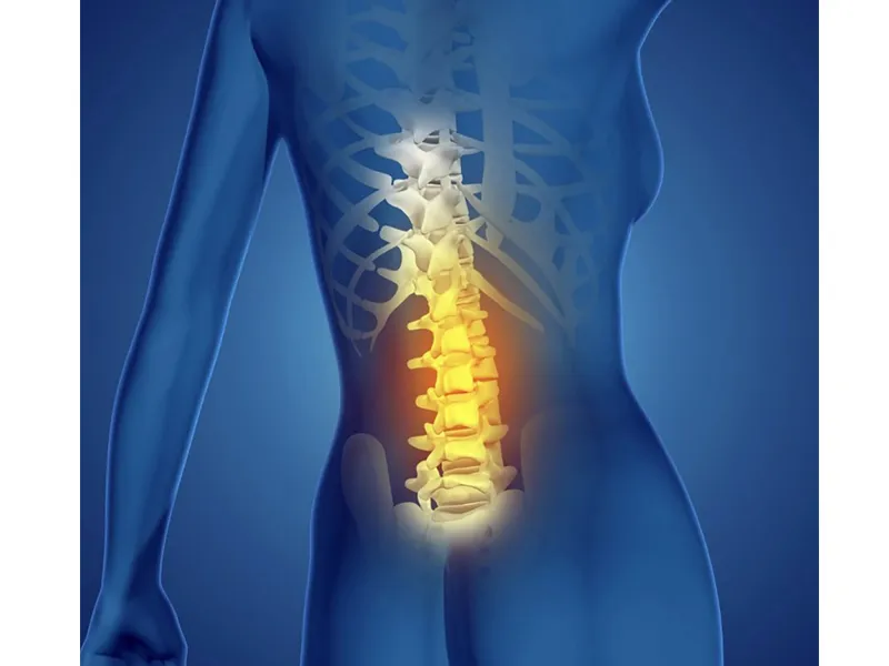 Thoát vị đĩa đệm là 1 nguyên nhân gây ra ngồi lâu bị đau lưng