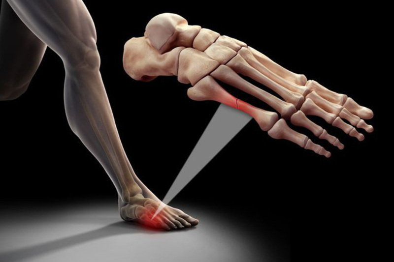 Gãy xương bàn chân là tình trạng xương bị vỡ, nghiền nát hay uốn cong do nhiều nguyên nhân khác nhau