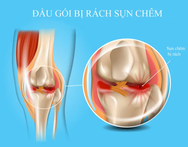 Sụn tổn thương dẫn đến đau đầu gối khi leo cầu thang