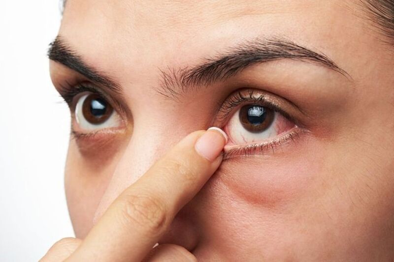 Đau nhức hốc mắt là biểu hiện của một số bệnh lý nguy hiểm