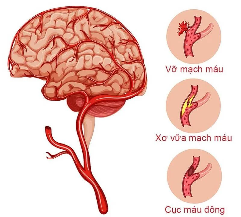 Dị dạng mạch máu não gây ra tai biến