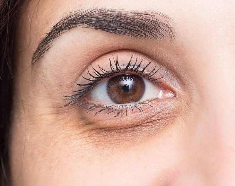 Việc xuất hiện bọng mắt thường gây nên tình trạng sưng nhẹ ở mí mắt, chảy xệ ở vùng da mắt xung quanh và thường đi kèm cùng quầng thâm