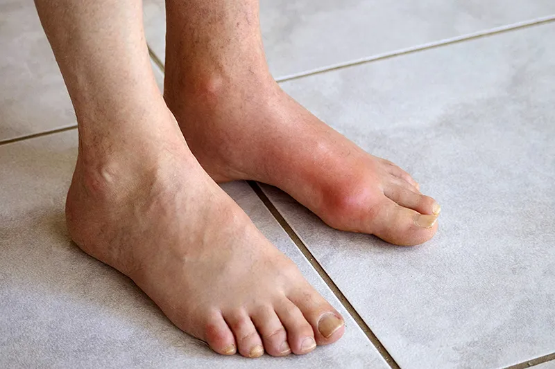 Nhức mỏi tay chân ở người trẻ có thể là cảnh báo bệnh lý nghiêm trọng nào? 