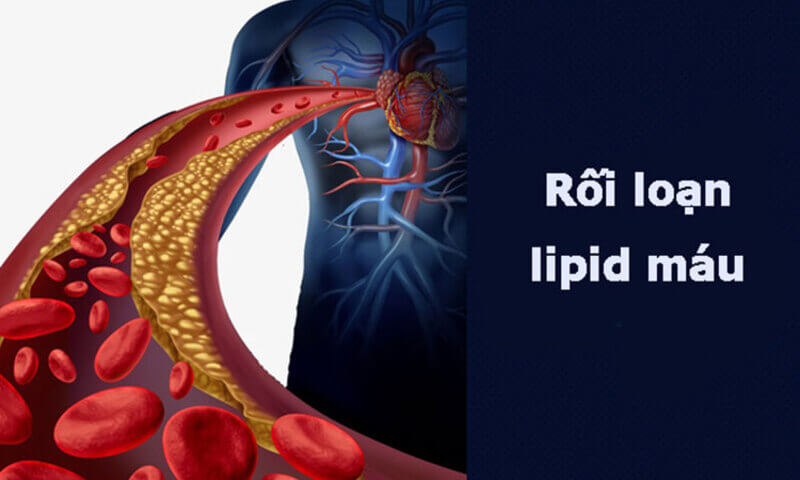 Rối loạn chuyển hóa lipid là gì? Người có dấu hiệu rối loạn chuyển hóa lipid máu nên ăn gì?