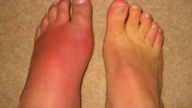 Nguyên nhân khiến mu bàn chân bị sưng đau là gì? 