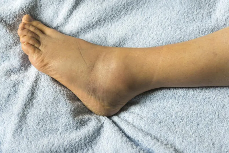 Sưng mu bàn chân là bệnh gì đang cảnh báo sức khỏe bạn? 