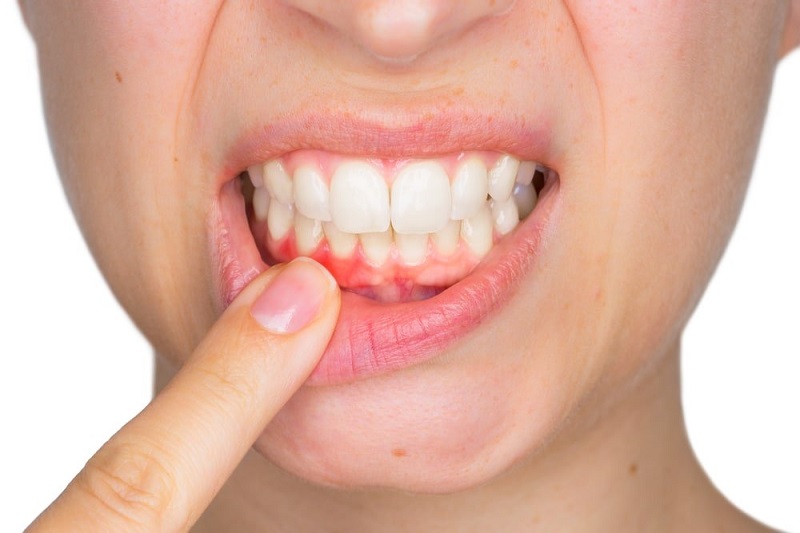 Cao răng mang lại những bất tiện gì?