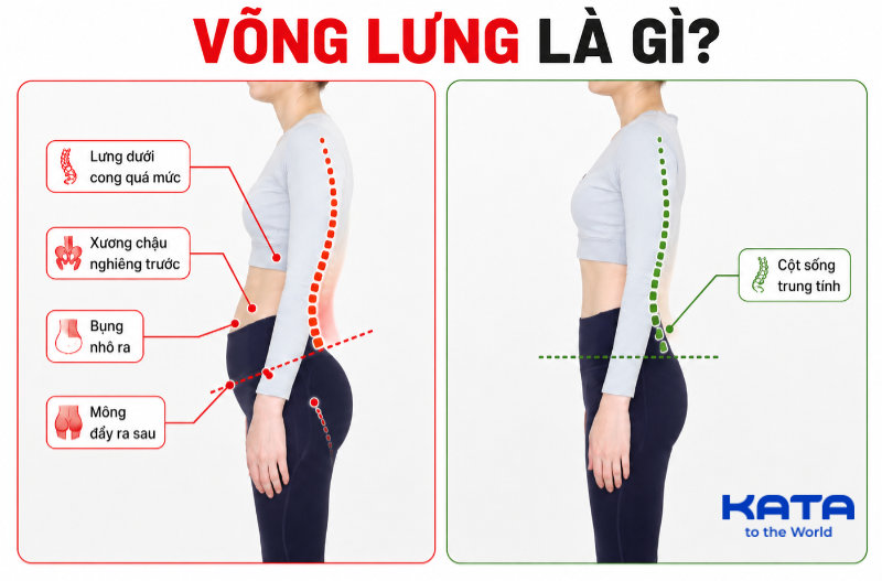 Võng lưng là gì: Nguyên nhân và cách cải thiện tại nhà